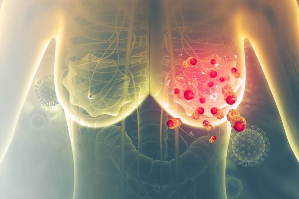 methode avirose cancer du sein