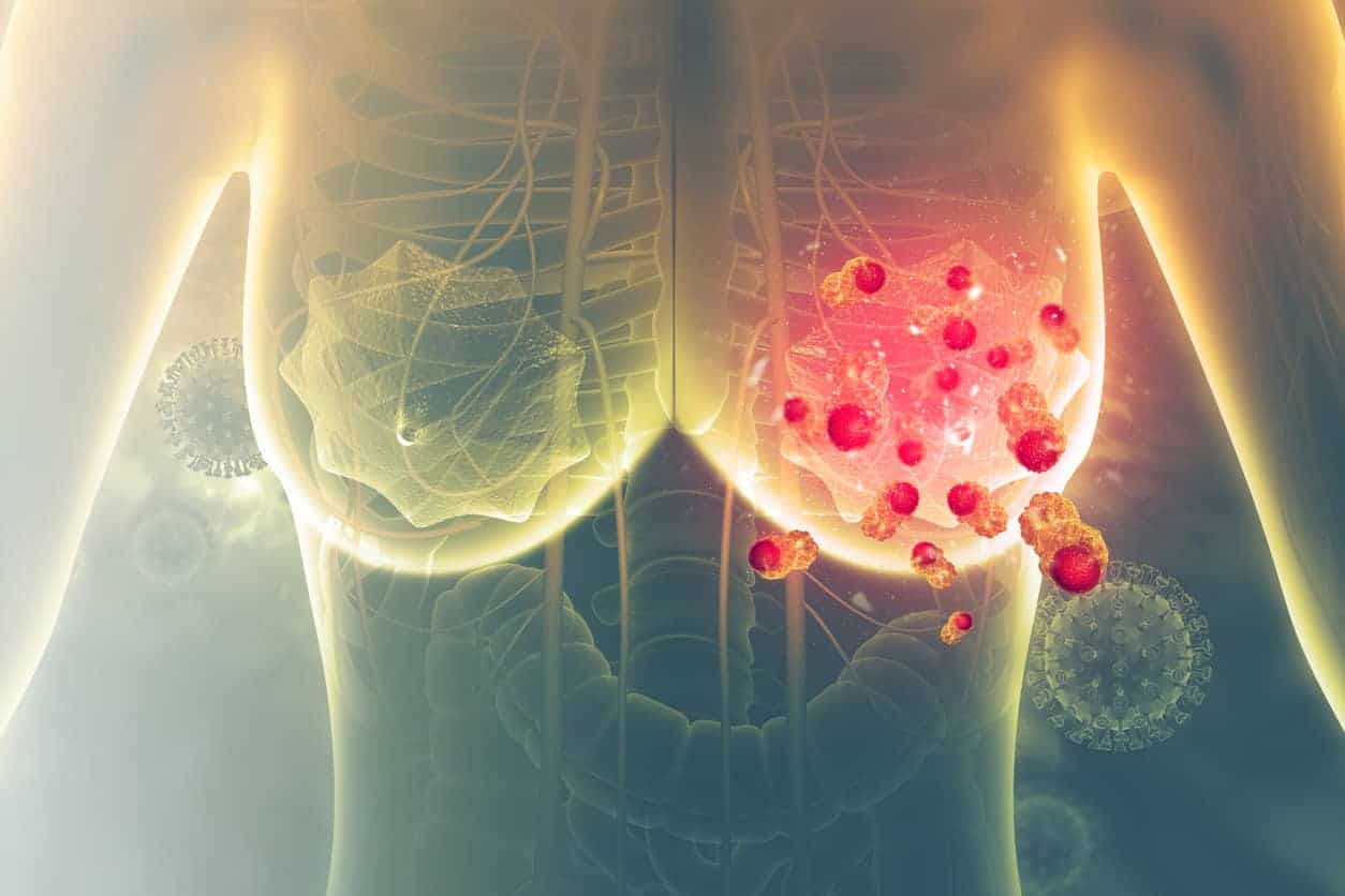 methode avirose cancer du sein